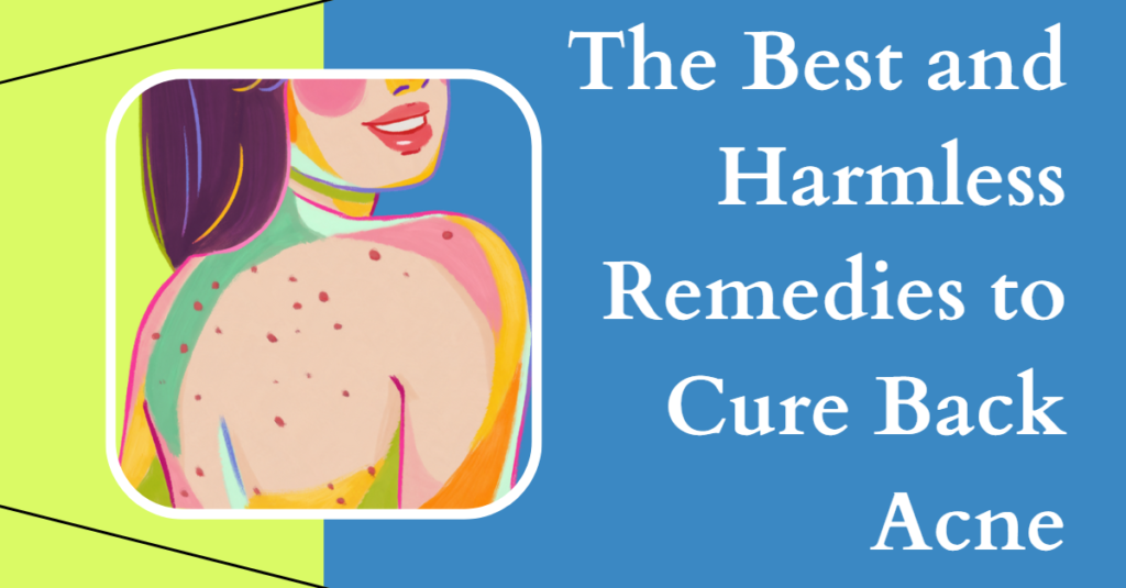 The Best and Harmless Remedies to Cure Back Acne